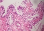 104_ADENOCARCINOMA_ACINAR.jpg