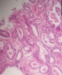 106ADENOCARCINOMA_ACINAR_.jpg