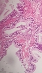 115ADENOCARCINOMA_ACINAR_.jpg