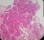 117adenocarcinoma_moderad.jpg