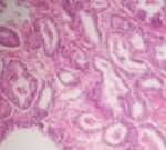 128ADENOCARCINOMA_ACINAR_.jpg