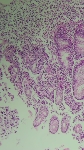 156ADENOCARCINOMA_GASTRIC.jpeg