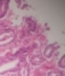 167ADENOCARCINOMA_ACINAR_.jpg