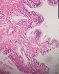 177ADENOCARCINOMA_ACINAR_.jpg