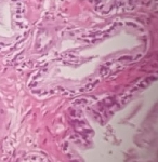 210ADENOCARCINOMA_ACINAR_.jpg