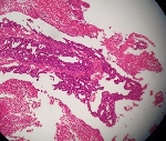 234ADENOCARCINOMA_MODERAD.jpg