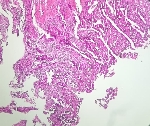 255ADENOCARCINOMA_DIF_ULC.jpg