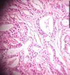 268ADENOCARCINOMA_ACINAR_.jpg