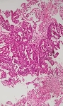 319CECO_adenocarcinoma.jpg