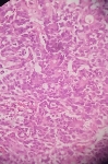 352RETO_ADENOCARCINOMA_MO.jpg