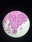 372ADENOCARCINOMA_DIF_ULC.jpeg