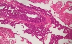 386COLON_ADENOCARCINOMA_M.jpg