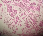 477ADENOCARCINOMA_MODERAD.jpg