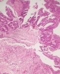 498ADENOCARCINOMA_MODERAD.jpg