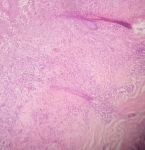 512CARCINOMA_BASOCELULAR_.jpg