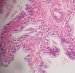 588ADENOCARCINOMA_ACINAR_.jpg