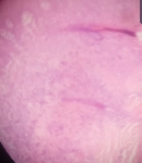 927CARCINOMA_BASOCELULAR_.jpg