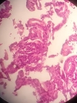 962ADENOCARCINOMA_MODERAD.jpg