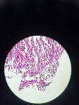 972ADENOCARCINOMA_DIF_ULC.jpeg