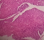 980ESF_DISTAL_ADENOCARCIN.jpg